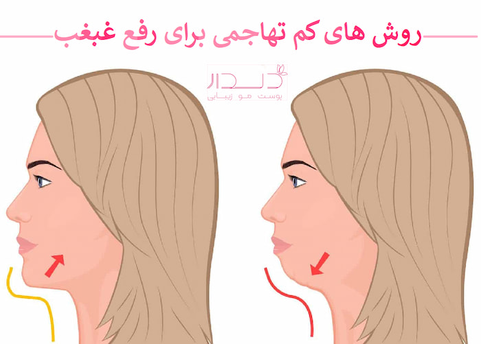 روشهای کم تهاجمی و پزشکی رفع غبغب