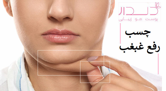 چسب رفع غبغب و بررسی اثرات موقت آن