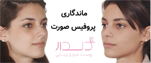 ماندگاری پروفیس صورت چقدر است؟