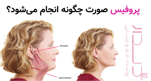 پروفیس صورت چگونه انجام می‌شود؟