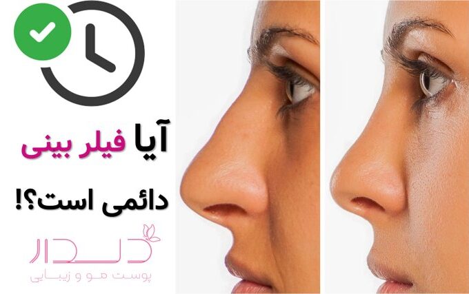 ایا فیلر بینی دائمی است؟