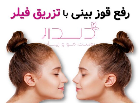 قوز بینی قبل و بعد با فیلر