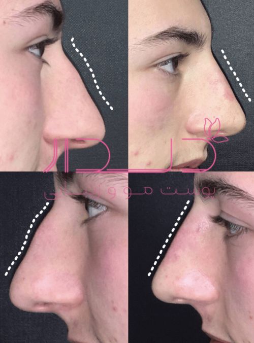 تزریق ژل به بینی قبل و بعد