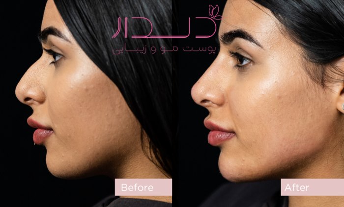 عکس قبل و بعد فیلر بینی عکس فیلر بینی استخوانی