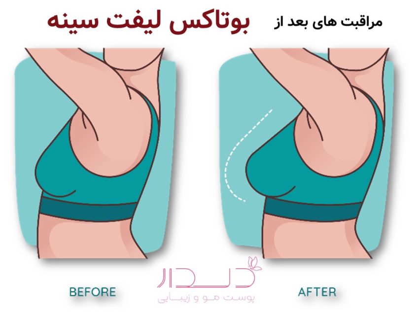 مراقبت های بعد از بوتاکس لیفت سینه