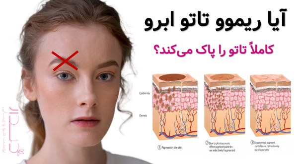 آیا ریموو تاتو کاملا تاتو را پاک می کند؟