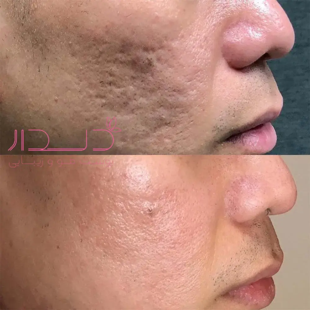 کدام لیزر برای جای جوش بهتر است؟/ تفاوت اربیوم، فرکشنال و IPL