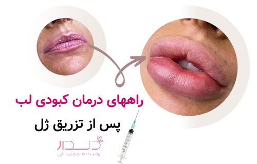 راههای درمان کبودی لب پس از تزریق ژل