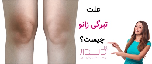 علت تیرگی زانو چیست