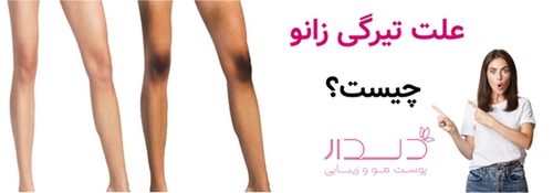 علت تیرگی زانو چیست؟