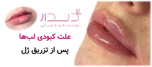 علت کبودی لبها پس از تزریق ژل
