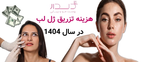هزینه تزریق ژل لب در سال 1404
