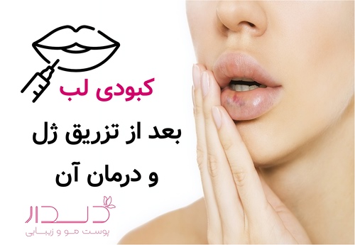 کبودی لب بعد از تزریق ژل و درمان آن