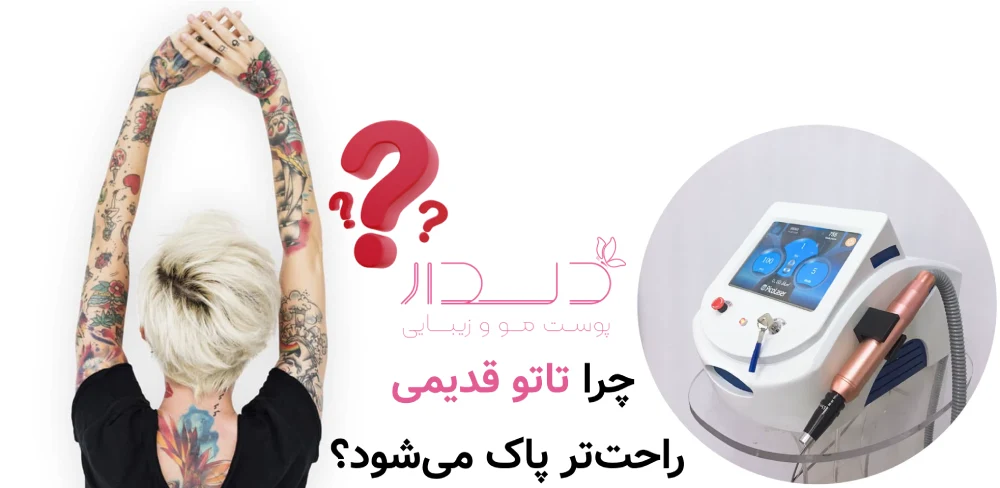 پاک کردن تاتوهای قدیمی راحت تر است یا جدید؟ چرا تاتو قدیمی راحت‌تر پاک می‌شود؟