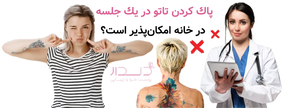 پاك كردن تاتو در يك جلسه چگونه است؟
