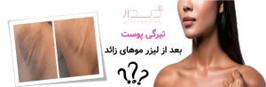 تیرگی پوست بعد از لیزر موهای زائد| چرا اتفاق می‌افتد و چگونه درمان می‌شود؟