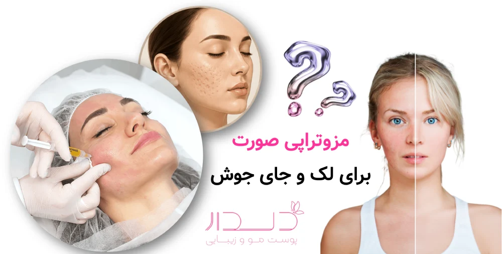 مزوتراپی صورت برای لک و جای جوش