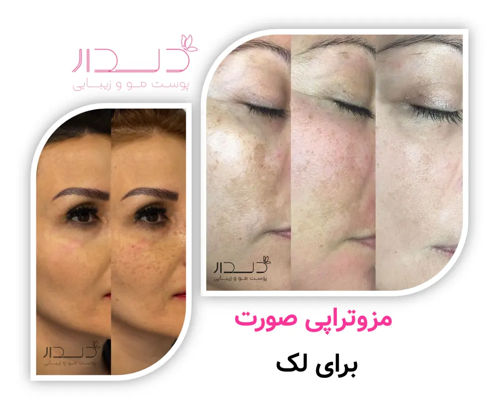  مزوتراپی صورت برای لک 