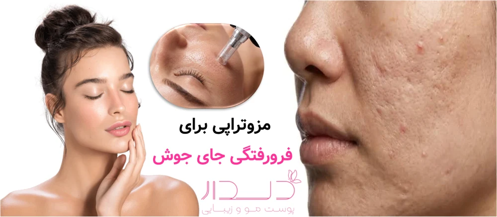 مزوتراپی برای فرورفتگی جای جوش