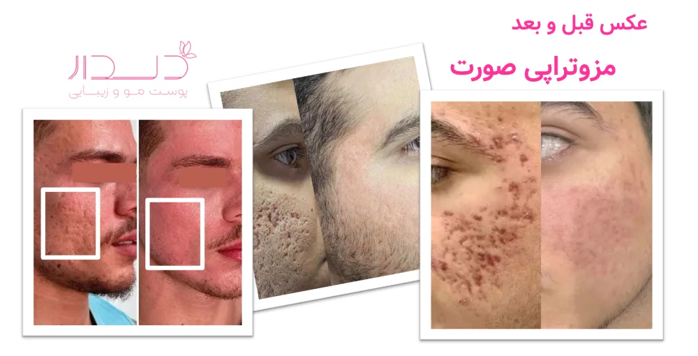 عکس قبل و بعد مزوتراپی صورت